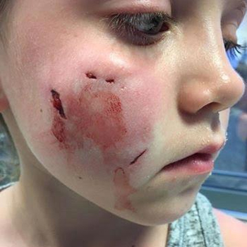  Deeper Dog Bite Treatment 